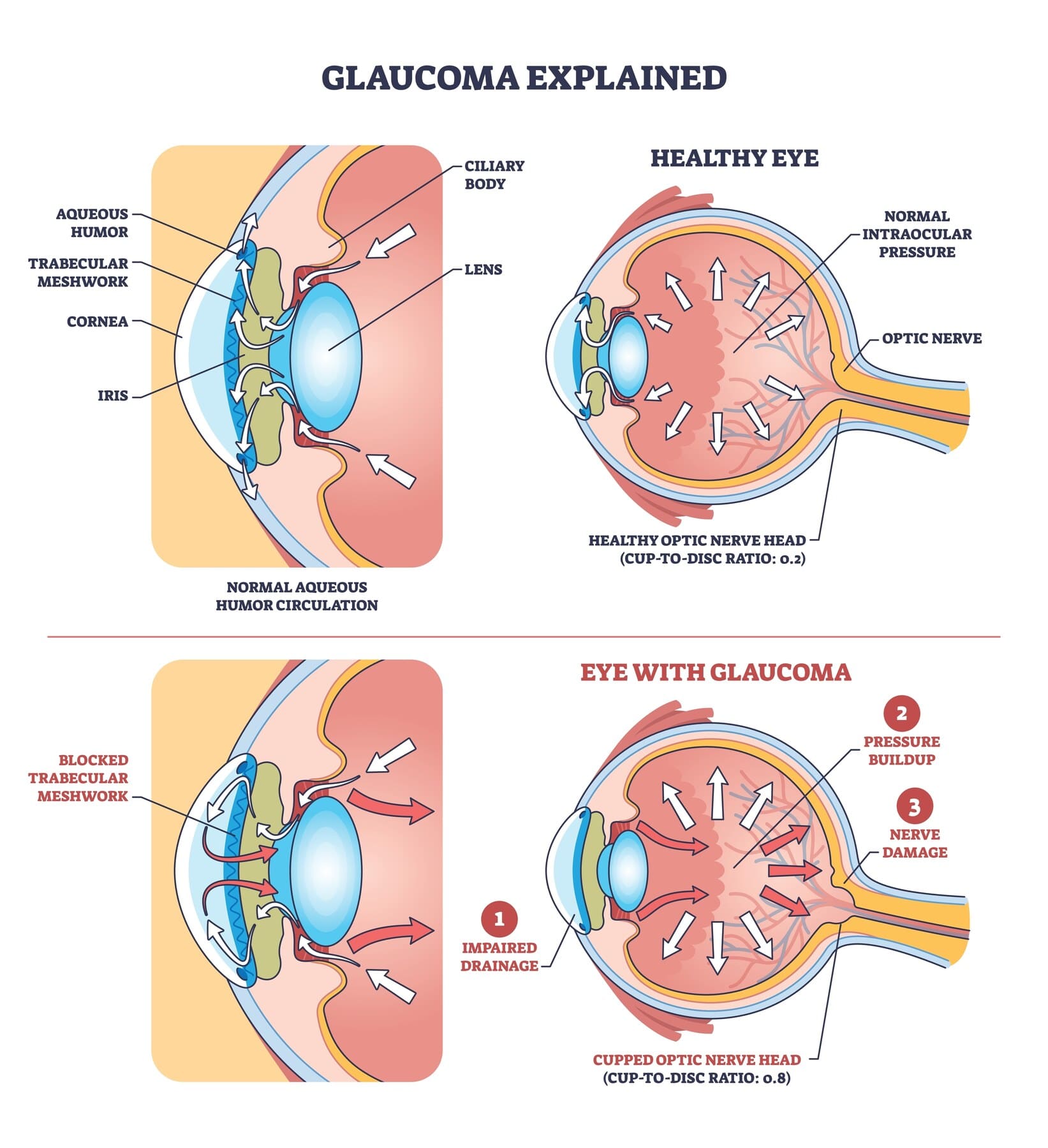 Diagram comparing a healthy eye, where aqueous fluid drains normally through the trabecular meshwork, with an eye affected by glaucoma, where impaired drainage raises intraocular pressure and cups the optic nerve head
