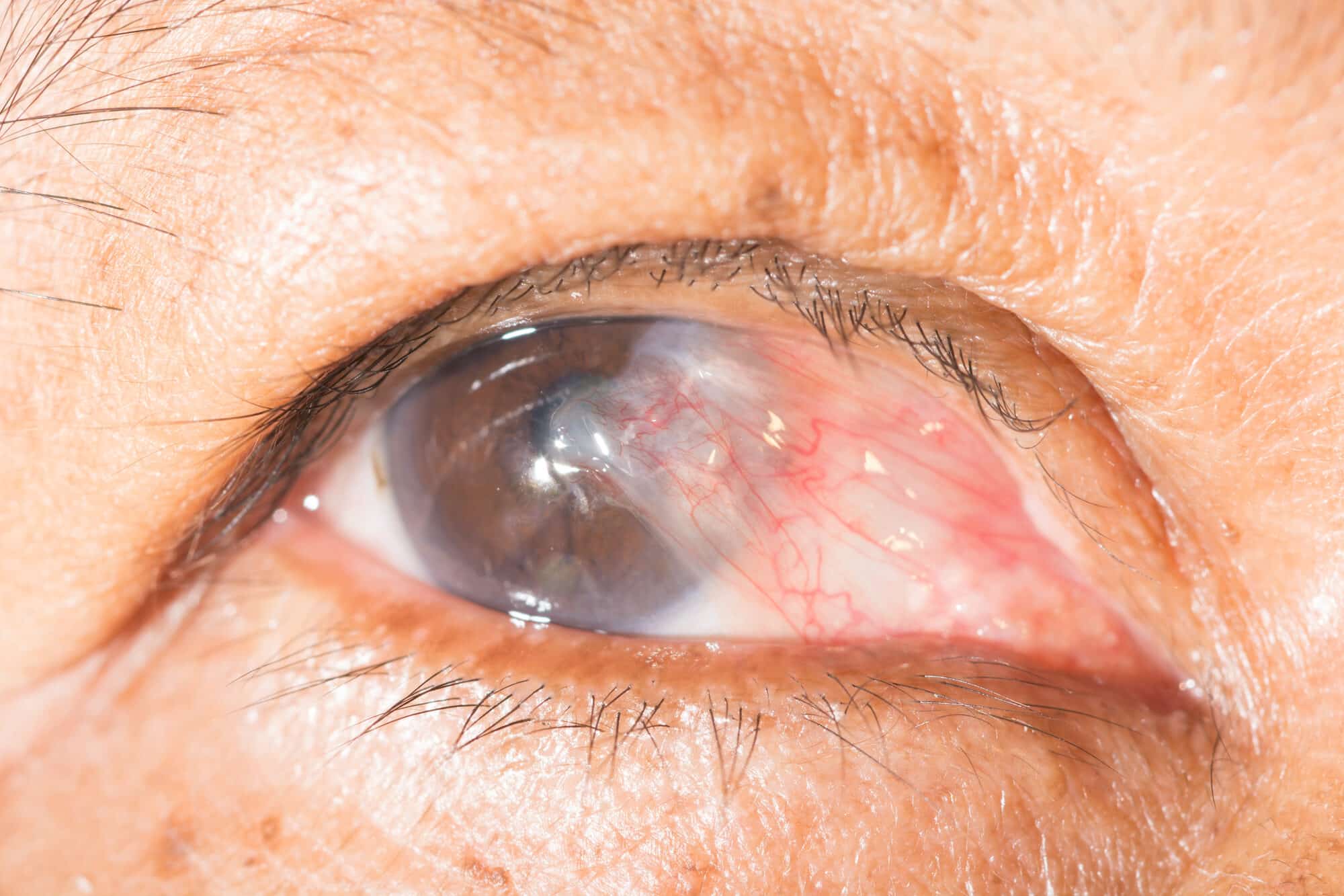 Close-up of a pterygium, a wedge of tissue growing from the white of the eye onto the cornea